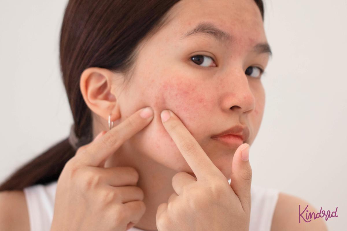 Acne Explained: What It Is, Why It Happens, and What to Do